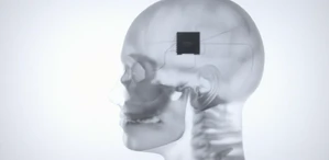 The Series 2000 implanted