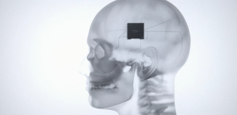 File:VAIIYA Series 2000 implant.png